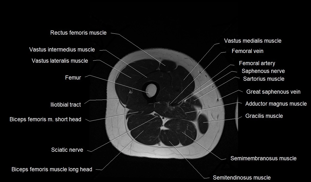 MRI thigh cross sectional anatomy image 37.webp